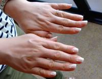 肌に赤みのある人は要注意！超簡単な「乳がん」の見分け方